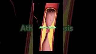 Atherosclerosis  Fat Deposit in Blood Vessel  Medical Condition atherosclerosis medicalcondition [upl. by Kries]