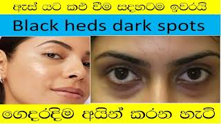 es yata kalu wenawata behethඇස් යට කළුවීමDark Circles and Wrinkles [upl. by Munster]