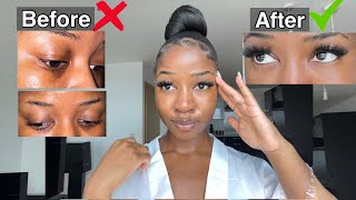 HOW TO GET RID OF DARK CIRCLES PERMANENTLY 👀 Fast and Effective [upl. by Leugimesoj755]