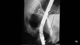 Cholangiopancréatographie rétrograde endoscopique [upl. by Georgia]