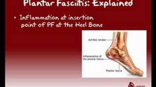 Plantar Fasciitis Explained [upl. by Aihtnys]