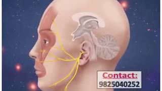 Trigeminal neuralgia treatment radio frequency ablation in ahmedabad gujrat [upl. by Atilek]