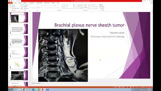 Brachial plexus schwannoma [upl. by Serra]