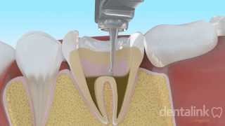 Endodoncia completa PASO A PASO  Video 3D [upl. by Analem]