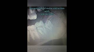 Extraction of impacted third molar 2  Dr Mazen Abdallah [upl. by Cila]