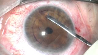 DMEK surgery sutureless corneal transplant [upl. by Theurich]