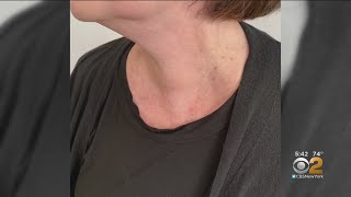 New Treatment For Risky Thyroid Nodules [upl. by Eceinwahs730]