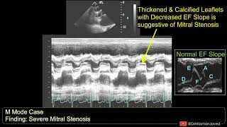 Mitral Stenosis on M Mode Echocardiogram  Echocardiography For Beginners [upl. by Bullivant]