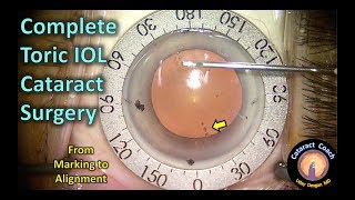 Toric IOL Cataract Surgery Complete from Marking to Alignment [upl. by Ennirroc]