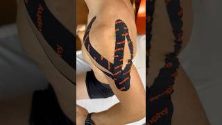 Inhibition of the deltoid muscle with Spophy kinesiology tape [upl. by Annam323]