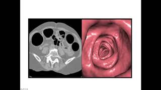 Virtual colonoscopy aka CT Colonography explained [upl. by Unders]