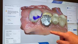 Cerec Tessera Workflow [upl. by Nylrahc]