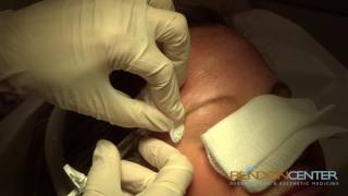 Filler for Forehead Wrinkles procedure [upl. by Vitale178]