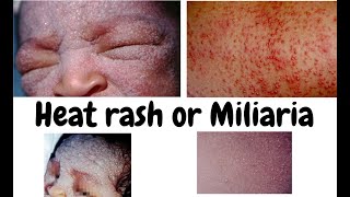 Heat rash Miliaria or Miliariapimples and rash due to heat or warmthDermatology lecture for MBBS [upl. by Eisnil]