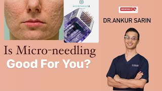 Facts about micro needling  Acne Scar Treatment  Dermapen 4  Morpheus 8 Dermaroller Dr Ankur [upl. by Gokey]