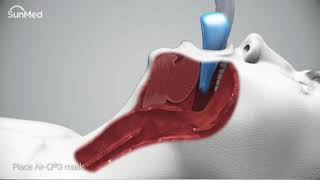 AirQ3®Intubating Laryngeal Airways InService Animation [upl. by Hays]