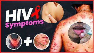 Early Signs of HIV AIDS in Men and Women  HIV Positive Signs [upl. by Wobniar]