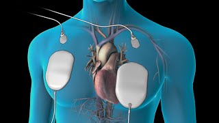 Cardioversion for Atrial Fibrillation [upl. by Ordisy]