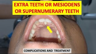 SUPERNUMERARY TEETH MESIODENS EXTRA TEETH COMPLICATIONS AND TREATMENT dentalcafe4331 [upl. by Burchett221]