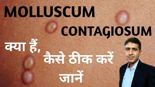 Molluscum Contagiosum क्या है कैसे पहचाने कारण व् होम्योपैथिक इलाज  Molluscum Contagiosum Ka Ilaj [upl. by Elyrrad]