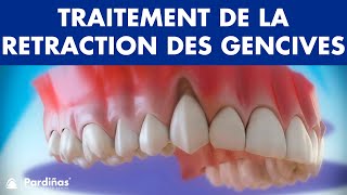 Récession Gingivale – Traitement de la retraction des gencives © [upl. by Almeeta]