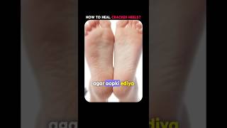 Cracked Heels solution by Dr Haritma Gupta  BBA Podcast  Anoop Kumar [upl. by Abroms]