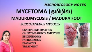 Mycetoma  Maduromycosis  Madura Foot  Subcutaneous mycoses  Dr Blessy  Tamil  Microbiology [upl. by Boru]