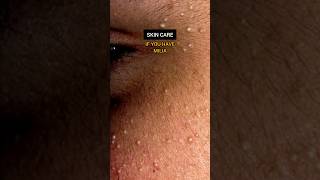 MILIA  TREATMENT  SKIN CARE TIPS  HEALTHY SKIN  CLEAR SKIN  SKIN CARE viral [upl. by Wayolle]