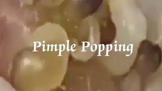 Pimples amp Blackheads Popping  37 [upl. by Calan969]