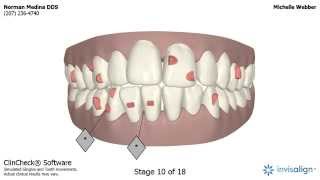 Invisalign Clincheck [upl. by Kristan]