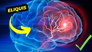 Eliquis The Revolutionary Anticoagulant for Stroke and Blood Clot Prevention [upl. by Bass]