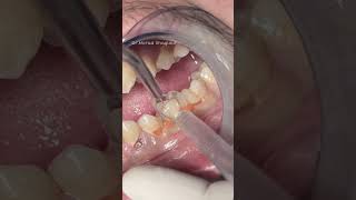 Class V composite restoration dentist satisfying [upl. by Hamlen]