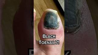 Why is my TOENAIL BLACK 😳 [upl. by Adlee916]