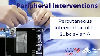 Percutaneous Intervention of LSubclavian A  June 26 2013 Live Case Video [upl. by Luing]