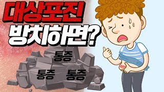 대상포진 방치하면 어떻게 될까 [upl. by Aramac]