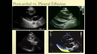 Pericardial Effusion Ultrasound Review [upl. by Allak]