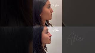 NonSurgical Rhinoplasty [upl. by Hodosh]