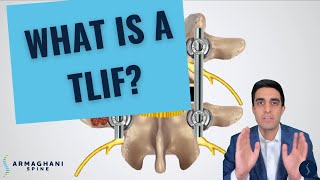 How I perform a TLIF and what to expect after [upl. by Seidler701]