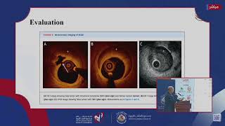 Day 3 Interventional Cardiology II [upl. by Clywd]