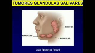 Tumores de Glándulas Salivales [upl. by Yelhs]