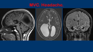 Corpus callosum agenesis radiology ultrasound radiologyresident neetpg [upl. by Bowlds]