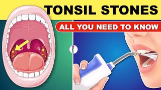 Tonsil Stones  Tonsil Stones Treatment  Tonsil Stone Removal  All You Need to Know [upl. by Akimahs]