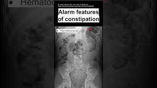 Alarm features of constipation [upl. by Naeruat]