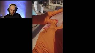 huge cyst explosions on this man back [upl. by Wixted443]