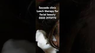 Leech therapy for face frackles chehrey ki jhayon ka elaj black spot treatment [upl. by Malloch]