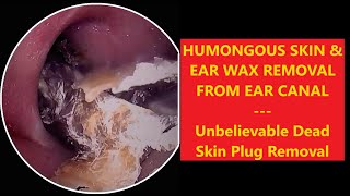 HUMONGOUS SKIN amp EAR WAX REMOVAL FROM EAR CANAL  EP70 relaxing satisfying asmr [upl. by Alitta]