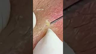 Pickel Ausdrücken Blackheads Akne amp Mitesser entfernen 🔴 34 [upl. by Eerised]