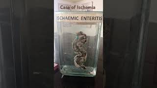 Ischemic Entritis case of ischemia of intestine likesharesubscribe MedicoMishtii [upl. by Oderfliw]