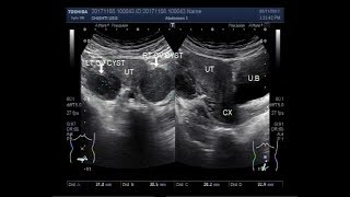 Ultrasound Video showing bilateral ovarian cysts [upl. by Elvin805]