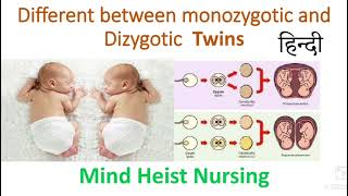 different between Monozygotic ampDizygotic twins Midwifery ampGynecology Explained in Hindi [upl. by Aicilana]